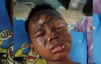 Tragedi Ramadan: Petasan Rakitan Meledak, Wajah Bocah SD di Indramayu Terluka Parah