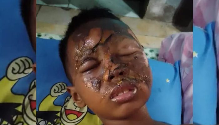 Tragedi Ramadan: Petasan Rakitan Meledak, Wajah Bocah SD di Indramayu Terluka Parah